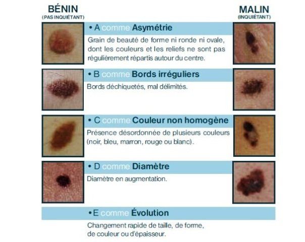 Journee De Depistage Des Cancers De La Peau Faites Vous Examiner Jeudi 22 Mai