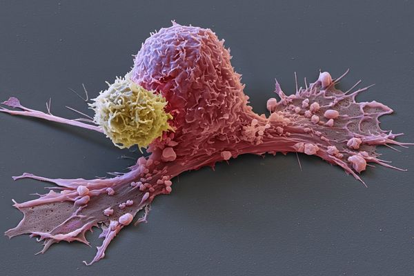 Une cellule cancéreuse (rose) attaquée par une Chimeric antigen Receptor (Car)-T-cell (en jaune). 