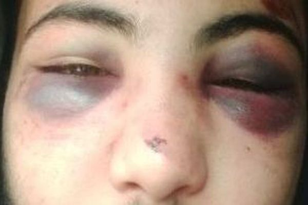 Sofiene, 19 ans, victime de violences policières lors de son interpellation à Koenigshoffen, dans la nuit du 18 au 19 mars dernier. 