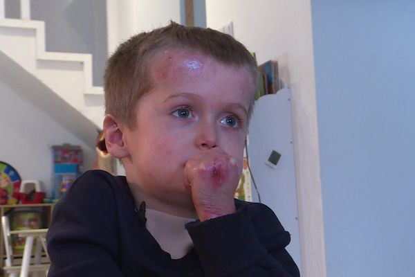 À 5 ans, Louis est atteint d’épidermolyse bulleuse. Il a des difficultés pour manger et boire.