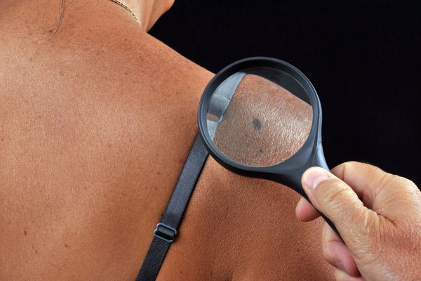 Cancers De La Peau Attention Aux Melanomes Les Conseils D Une Dermatologue Pour Se Proteger Du Soleil