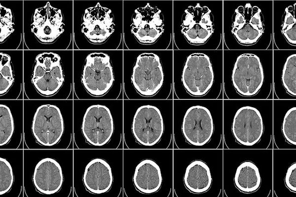 Le cerveau sous toutes les coutures, grâce à l'imagerie médicale