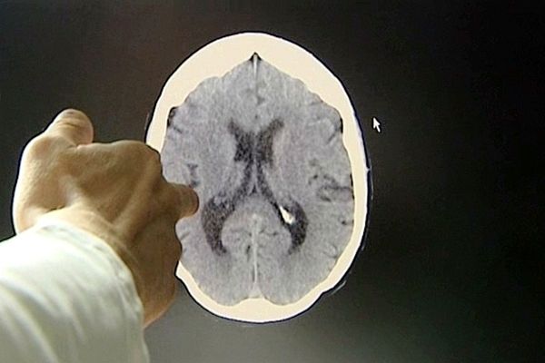 En cas d'AVC, il faut agir vite, car 1 minute perdue = 2 millions de neurones détruits