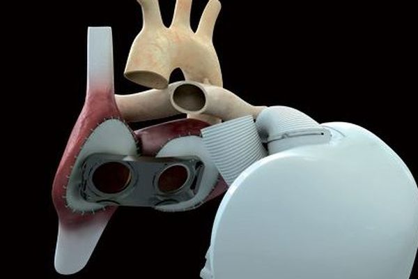 Le 18 decembre 2013 une première médicale mondiale, l'implantation d'un cœur artificiel a été réalisée à l'hopital européen Georges Pompidou, la prochaine implantation pourrait être réalisée à Nantes