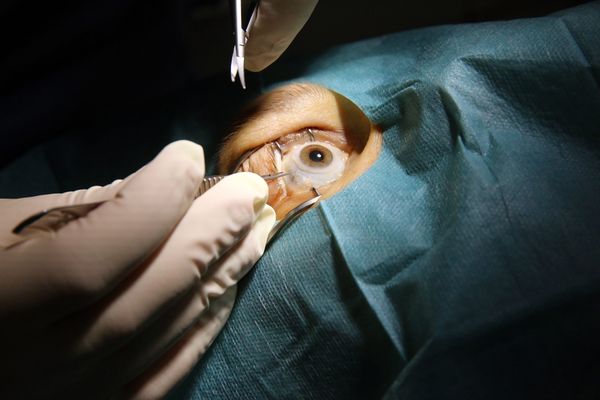 La cornée d'un œil prélevé dans un hôpital en Alsace.