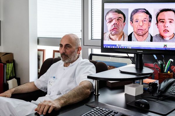 Le Pr Laurent Lantieri et son équipe de l'Hôpital européen Georges-Pompidou ont effectué la deuxième greffe de visage à Jérôme Hamon, en janvier 2018. Une première mondiale.