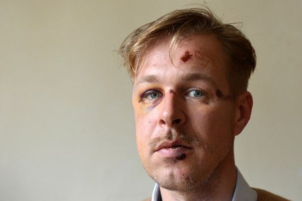 Wilfred de Bruijn, le 11 avril 2013, quelques jours après la violente agression.