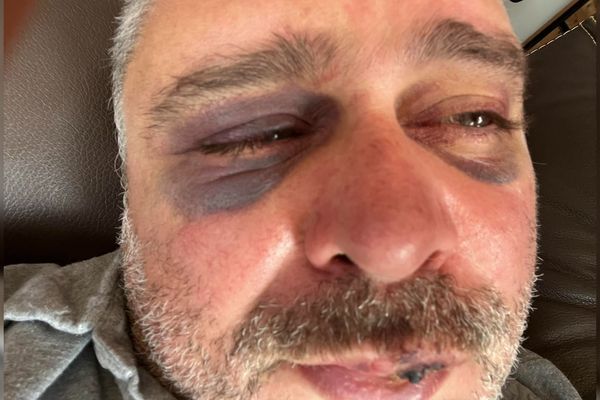 Alain, encore contusionné huit jours après son agression homophobe près de Mâcon