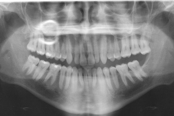 La prévention d'hygiène bucco-dentaire dans les écoles permet de dépister des problèmes de santé et d'inciter les enfants à bien se brosser les dents.