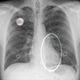 image d'illustration du cancer du poumon