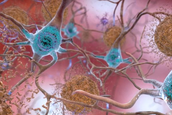 Le protocole de recherche du Lecanemab a mis en évidence un effet "modeste, mais significatif" sur l'évolution de la maladie d'Alzheimer.