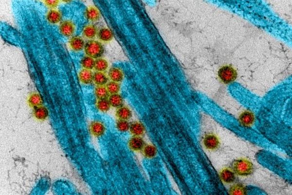 Les cellules "cibles" du Coronavirus SARS-CoV-2 (Covid 19) accrochés au niveau des cils de cellule épithéliale respiratoire humaine.