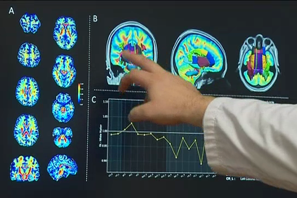 Après un arrêt cardiaque, analyse du pronostic neurologique par résonance magnétique