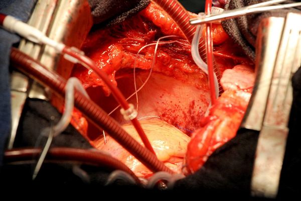 En 2016, un nombre statistiquement trop élevé de¨décès  suite à des greffes cardiaques a été constaté au CHU de Limoges.