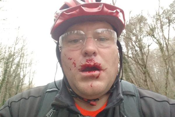 Christophe Rey, un Girondin blessé au visage par un câble tendu sur un chemin alors qu'il se promenait en VTT. 