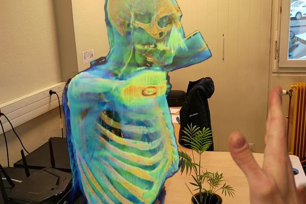 Les médecins pourraient observer "le scanner d’un patient rendu sous forme d’hologramme" d'ici quelques mois.