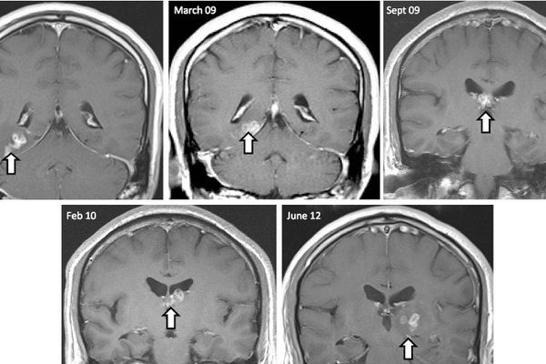 Un ver dans le cerveau d'un patient britannique.