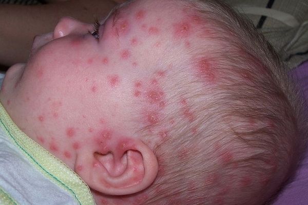 Visage d'un bébé ayant la varicelle.