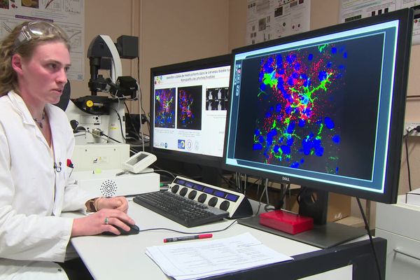 Les chercheurs s'intéressent à un traitement contre le glioblastome.